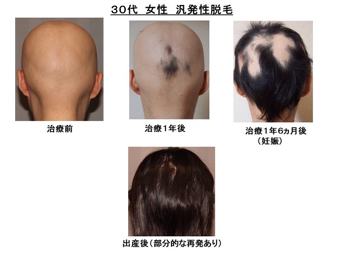 円形脱毛症　名医""